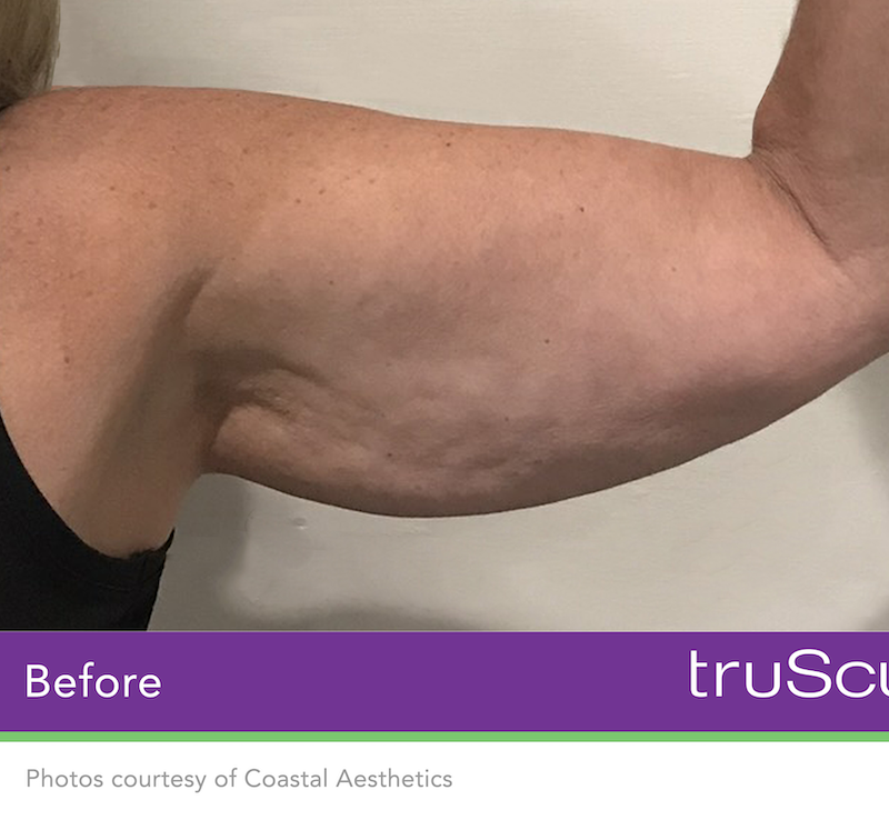 truSculpt iD Before & After Image