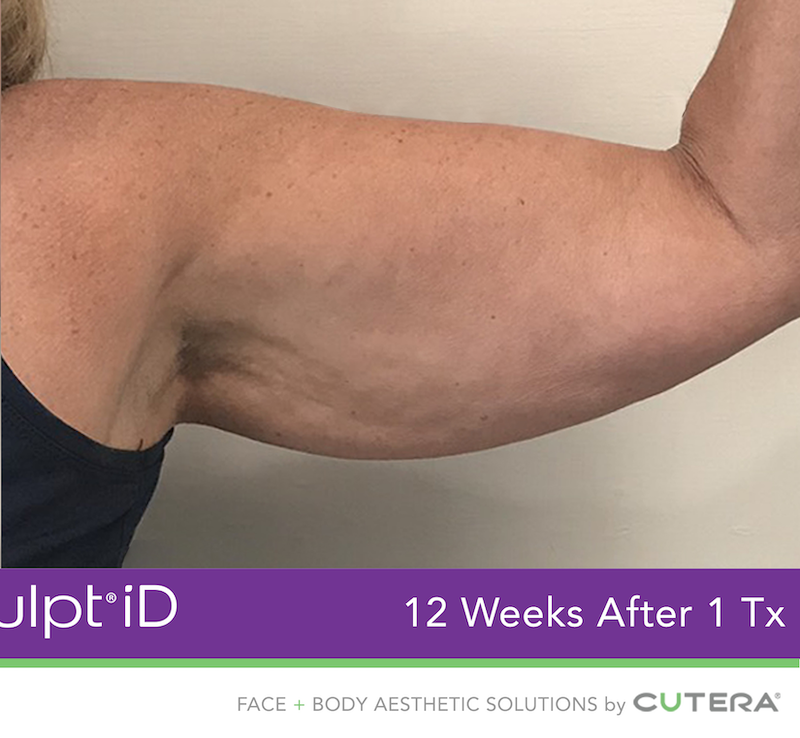 truSculpt iD Before & After Image