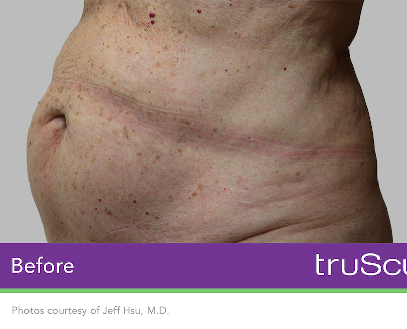 truSculpt iD Before & After Image