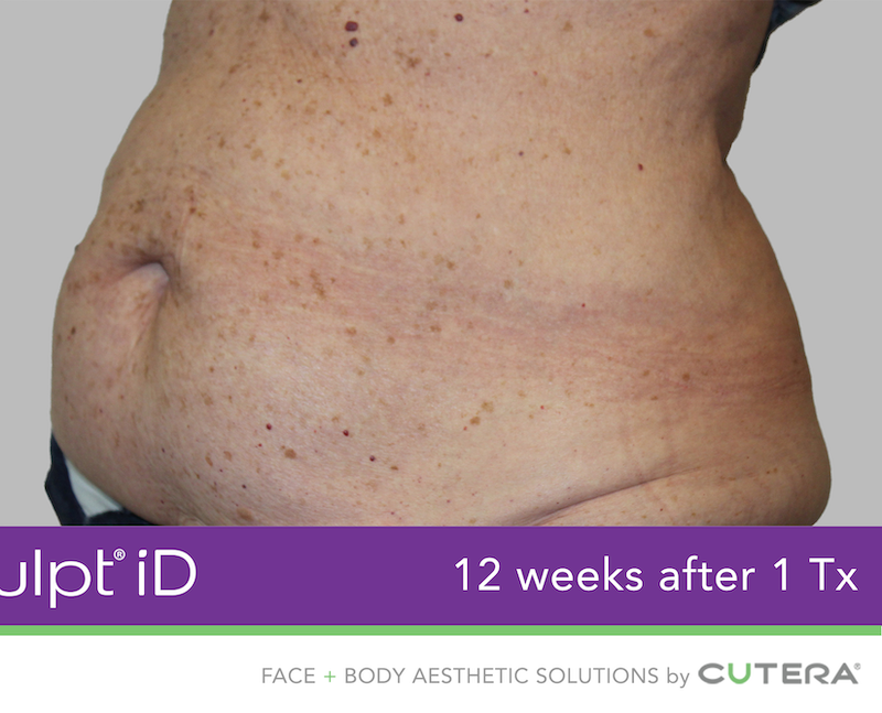 truSculpt iD Before & After Image