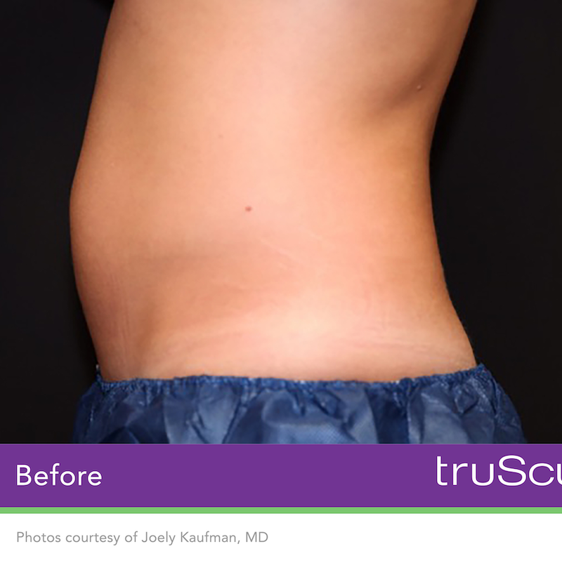 truSculpt iD Before & After Image