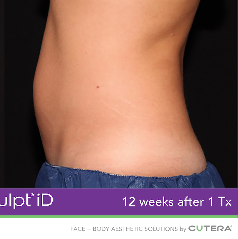 truSculpt iD Before & After Image