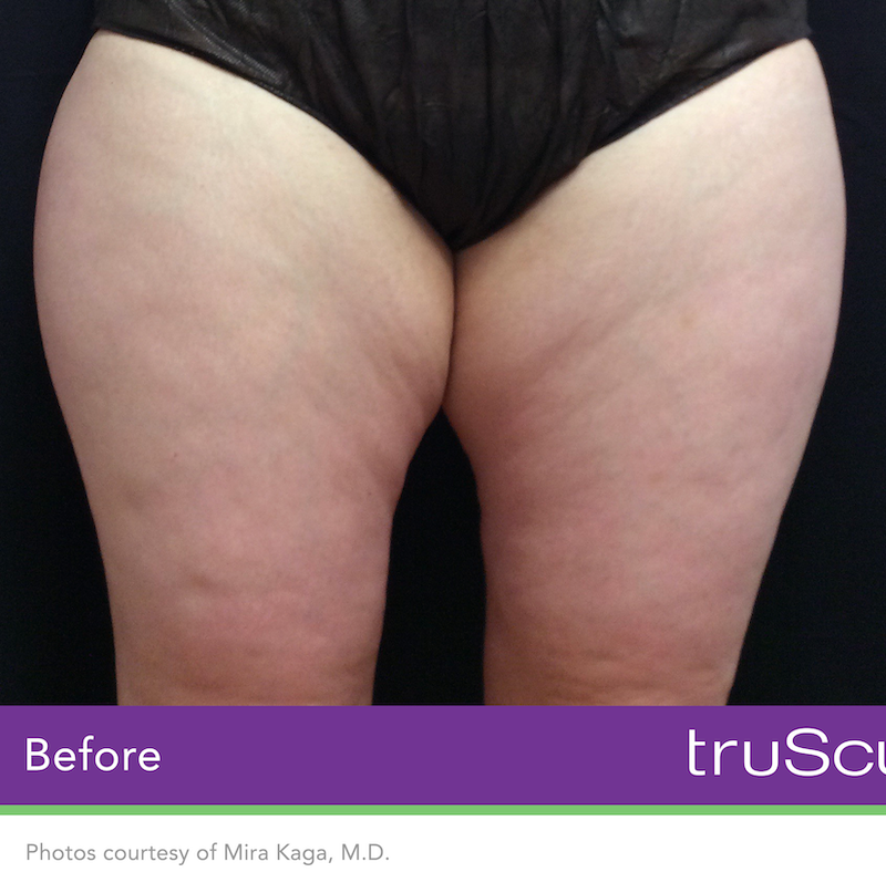 truSculpt iD Before & After Image