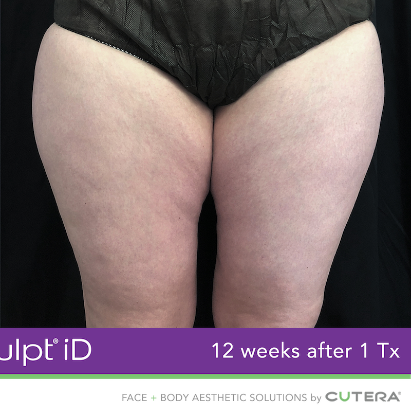 truSculpt iD Before & After Image