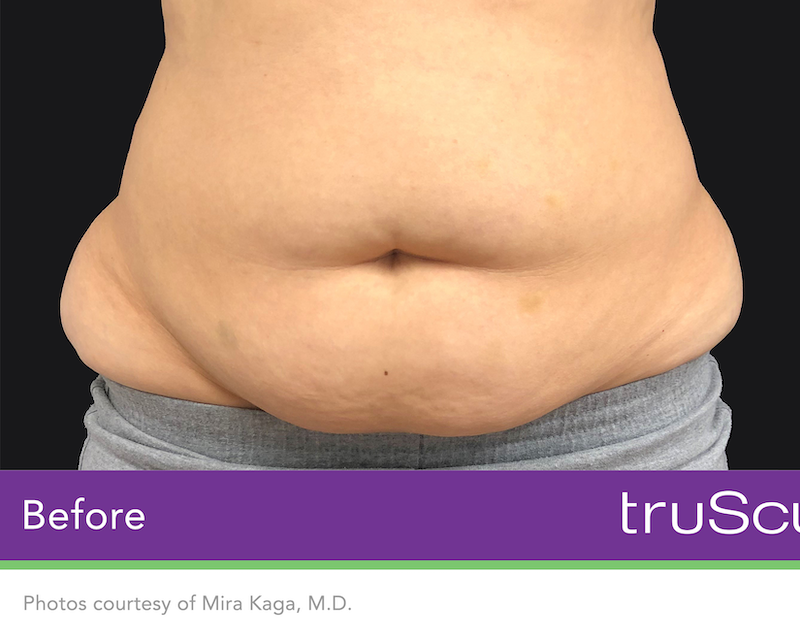 truSculpt iD Before & After Image