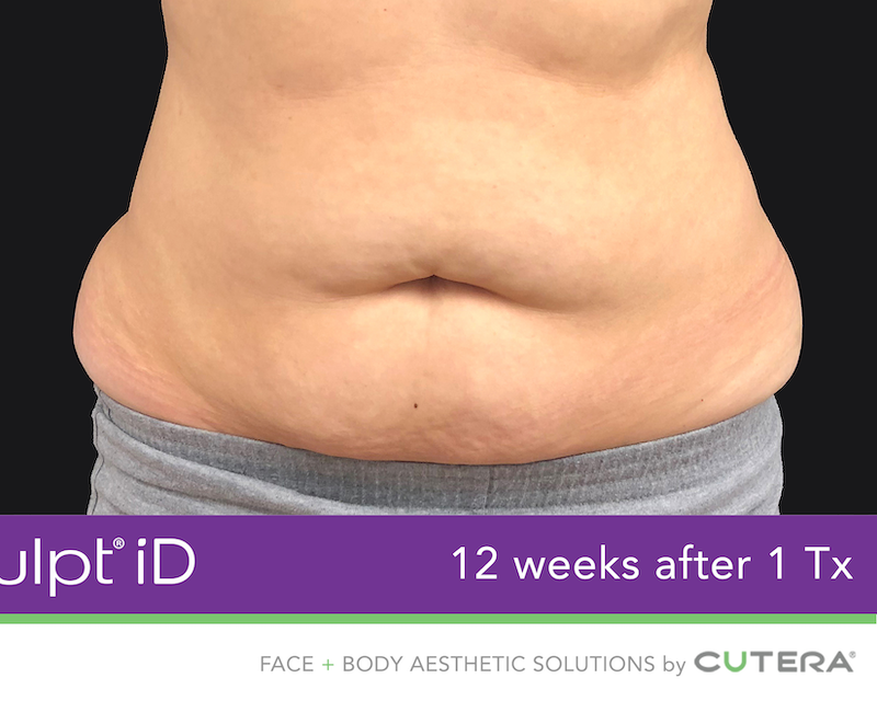 truSculpt iD Before & After Image