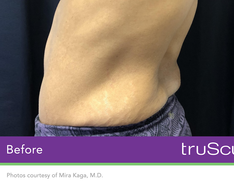 truSculpt iD Before & After Image