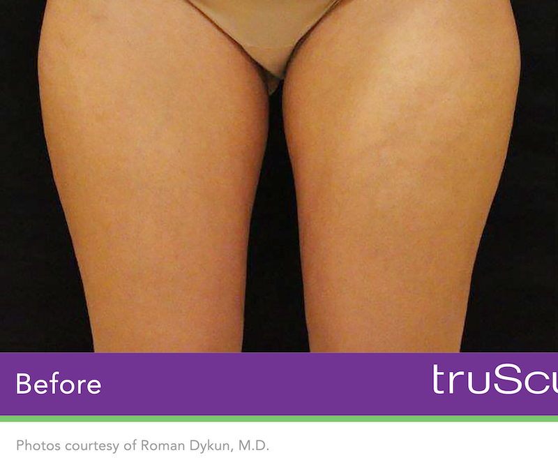 truSculpt iD Before & After Image