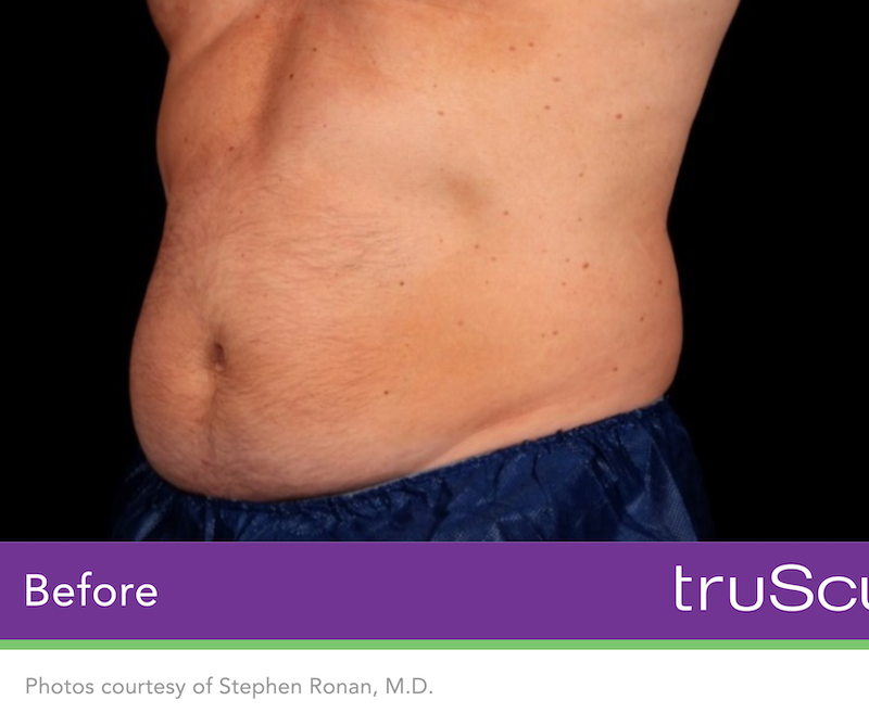 truSculpt iD Before & After Image