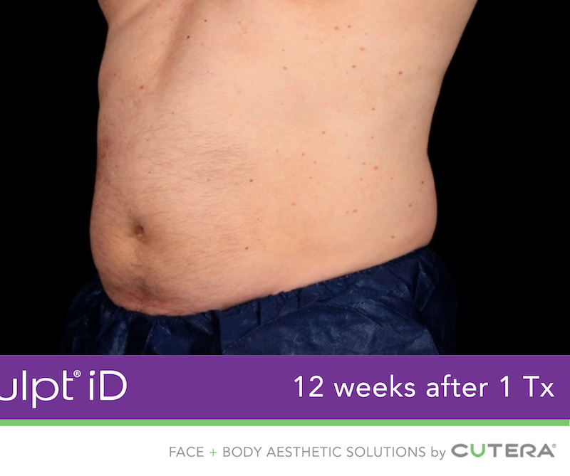 truSculpt iD Before & After Image