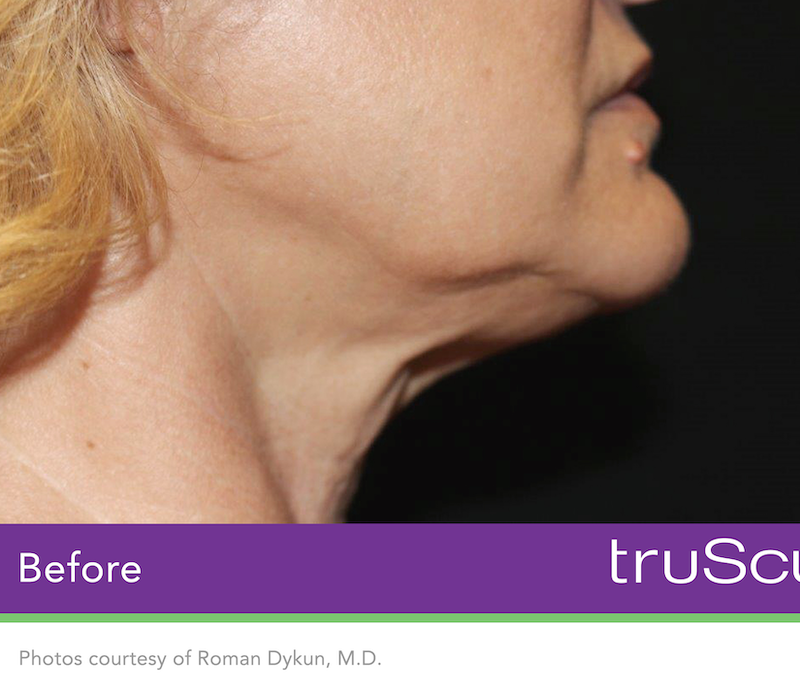 truSculpt iD Before & After Image