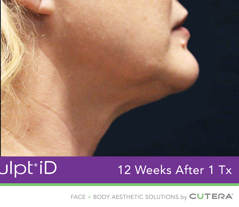 truSculpt iD Before & After Image