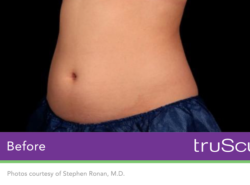 truSculpt iD Before & After Image