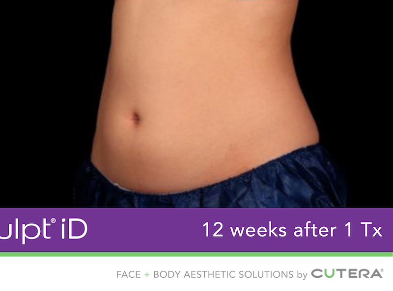 truSculpt iD Before & After Image