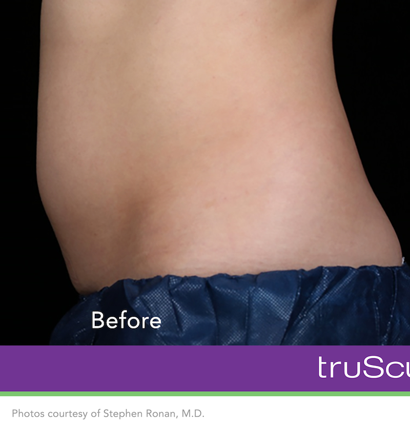 truSculpt iD Before & After Image