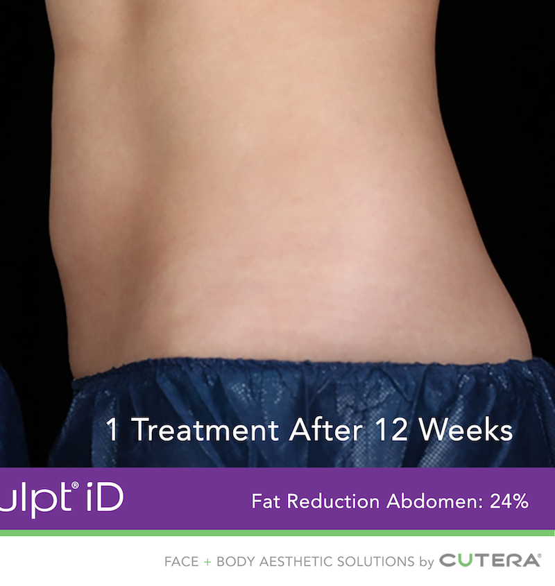 truSculpt iD Before & After Image