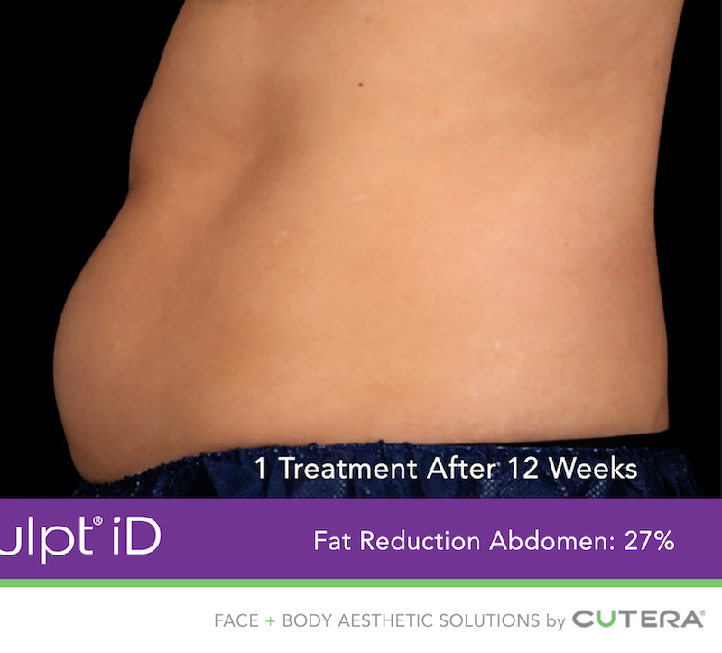 truSculpt iD Before & After Image