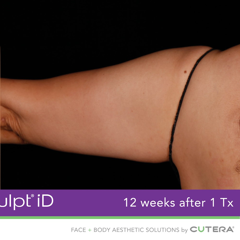 truSculpt iD Before & After Image