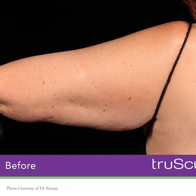 truSculpt iD Before & After Image