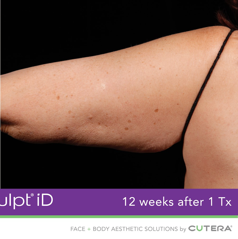 truSculpt iD Before & After Image