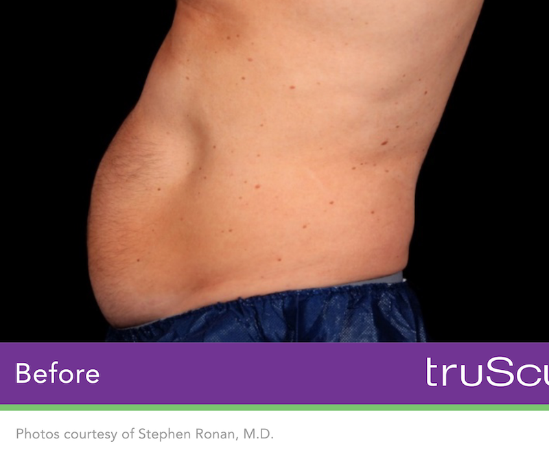 truSculpt iD Before & After Image