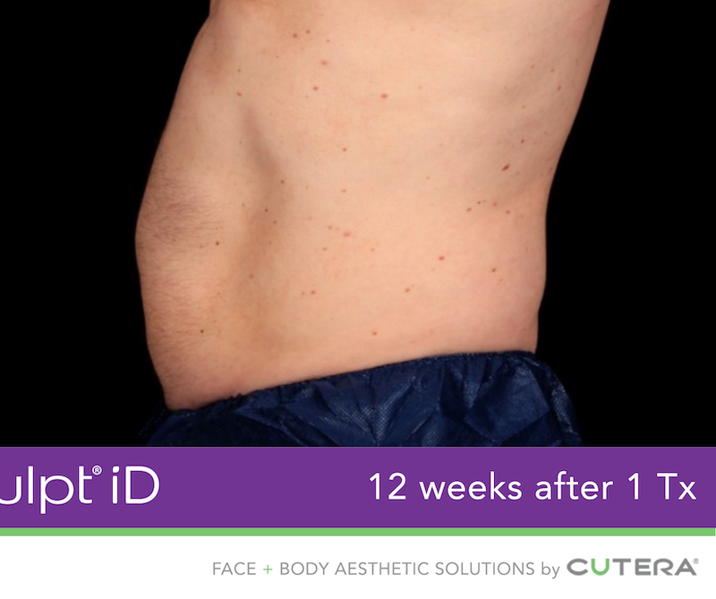 truSculpt iD Before & After Image