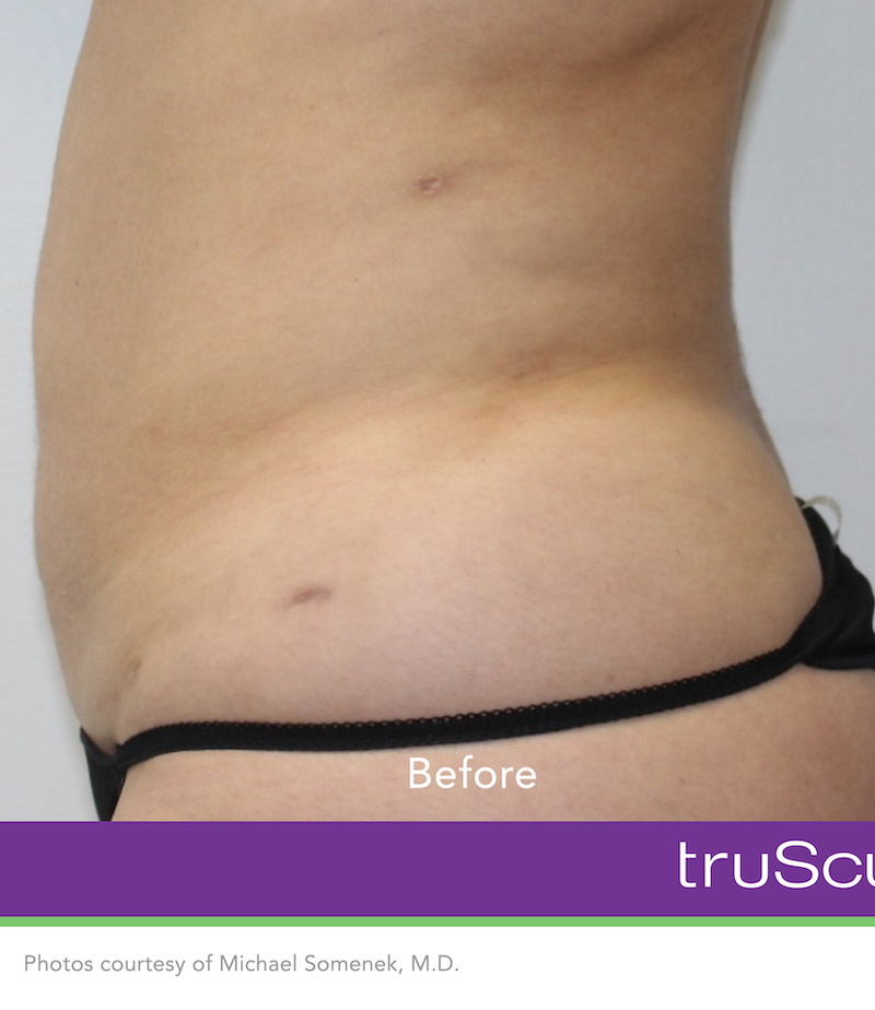 truSculpt iD Before & After Image