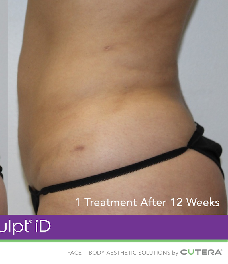 truSculpt iD Before & After Image