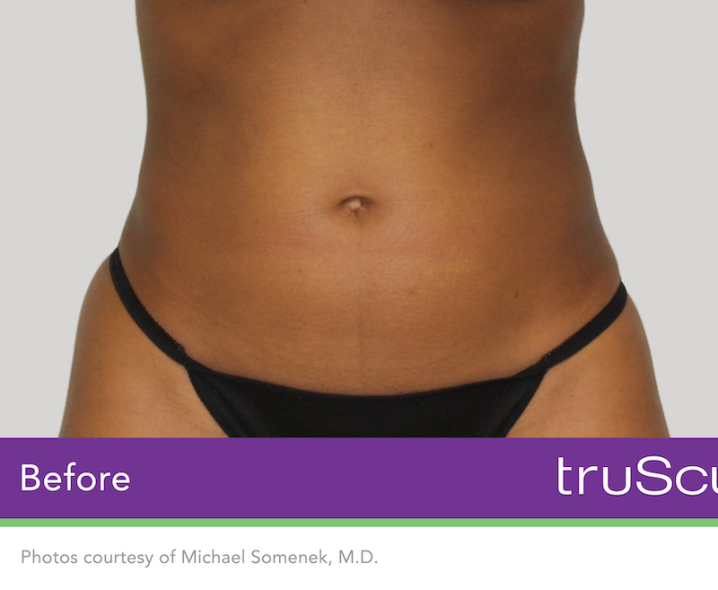 truSculpt iD Before & After Image