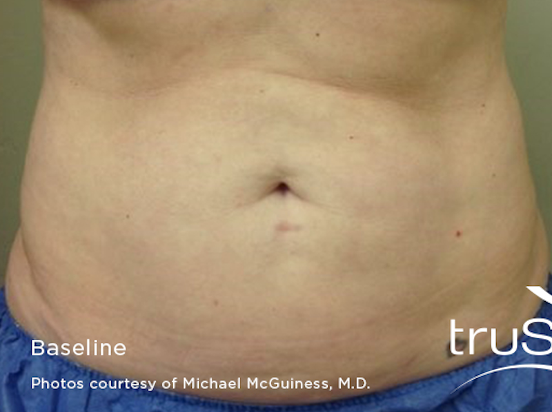 truSculpt Before & After Image