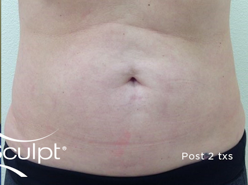 truSculpt Before & After Image