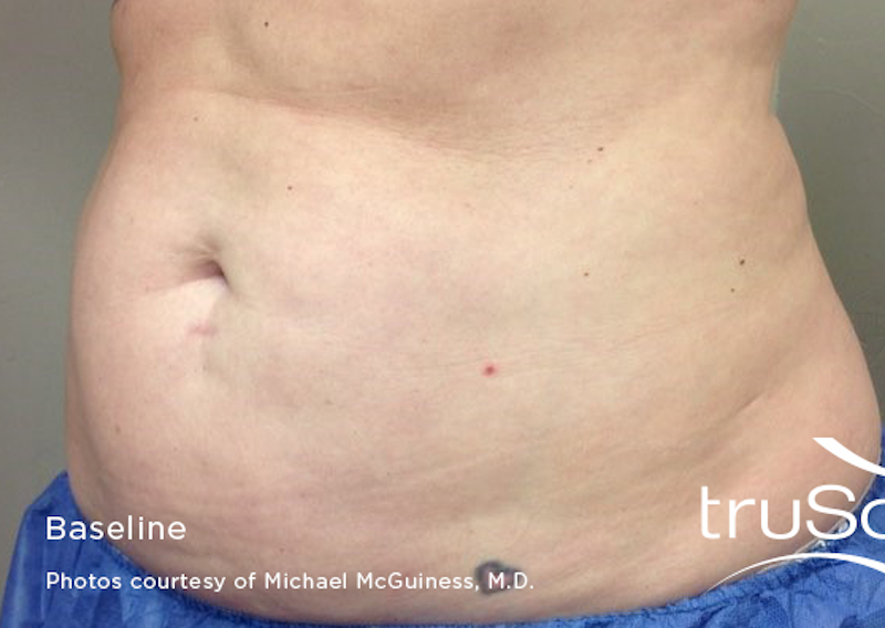 truSculpt Before & After Image