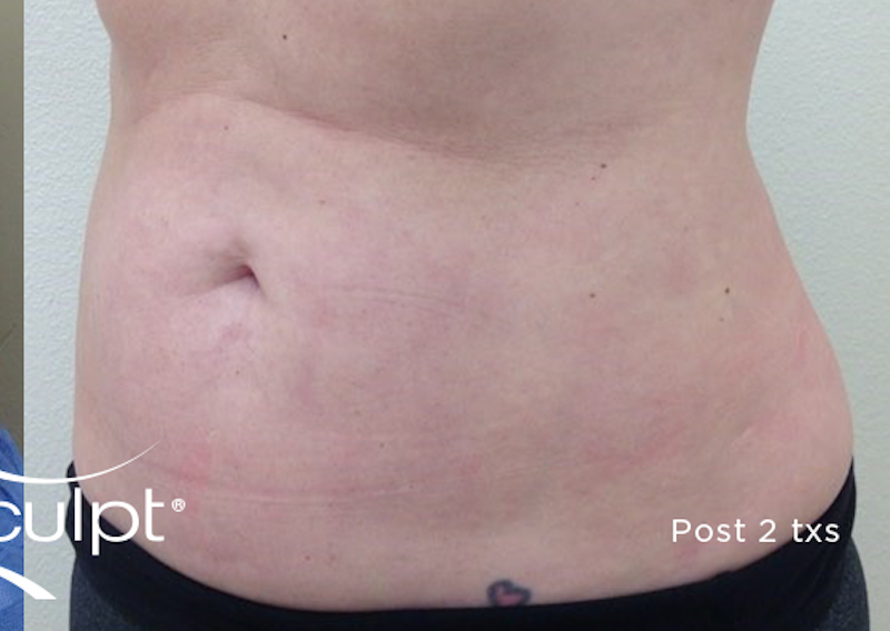 truSculpt Before & After Image