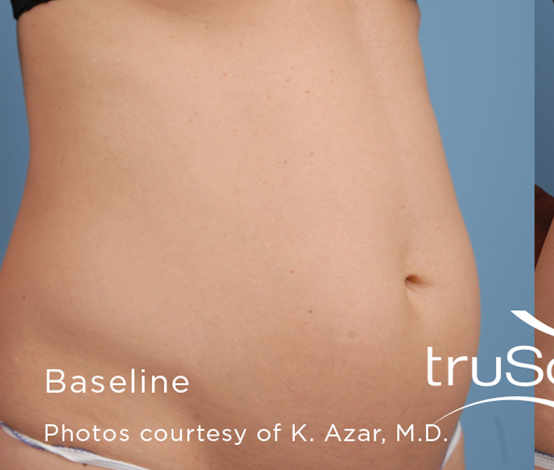 truSculpt Before & After Image