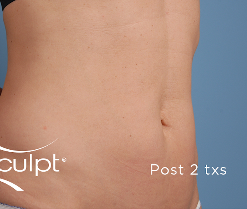 truSculpt Before & After Image