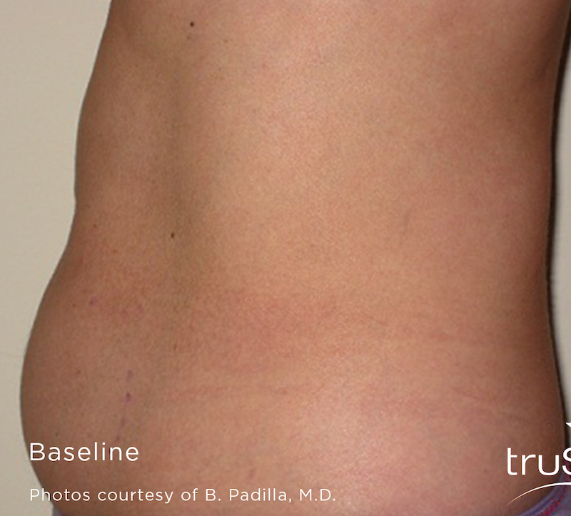 truSculpt Before & After Image