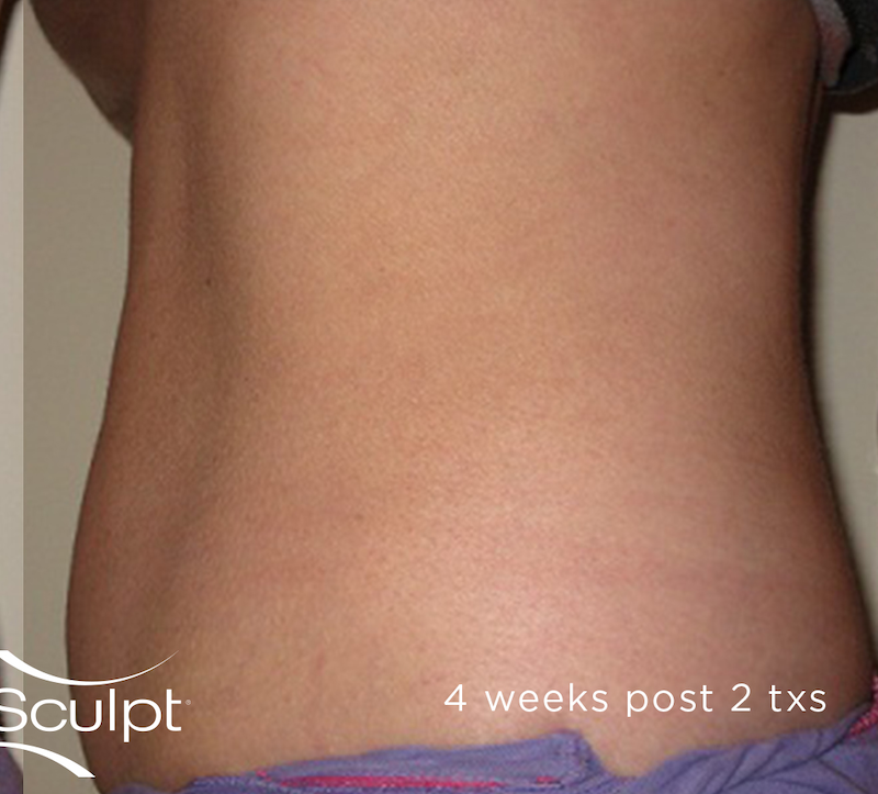 truSculpt Before & After Image