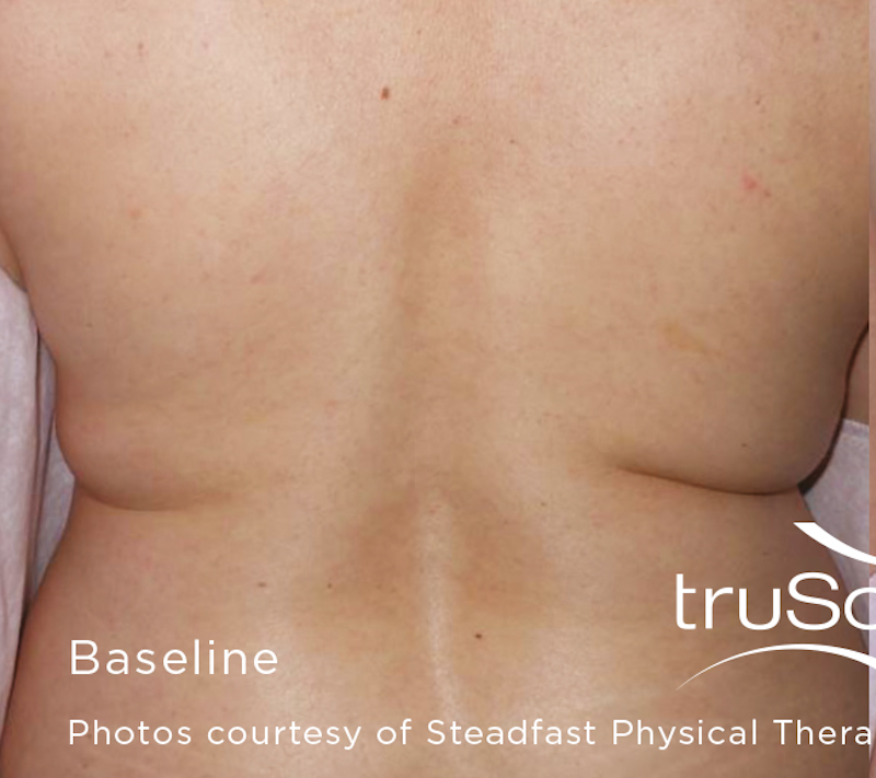 truSculpt Before & After Image