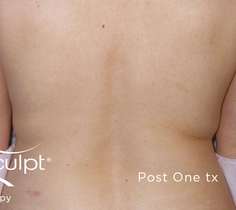 truSculpt Before & After Image