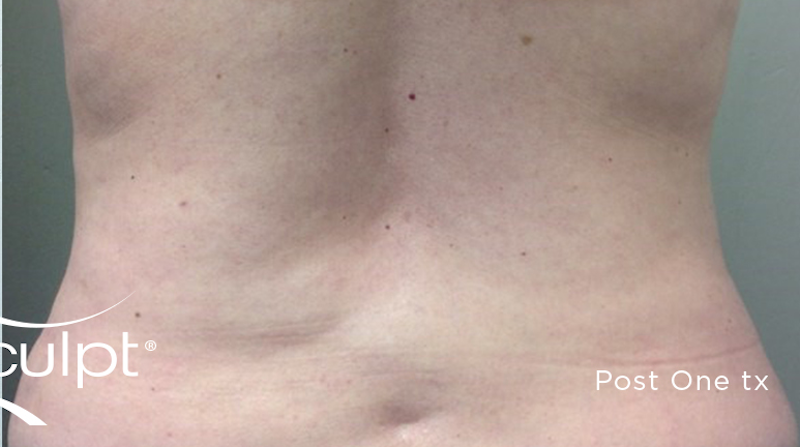 truSculpt Before & After Image