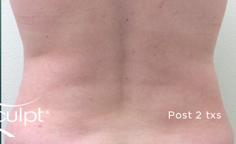 truSculpt Before & After Image