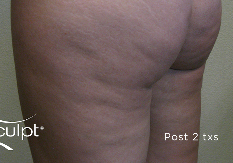 truSculpt Before & After Image