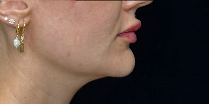 Chin Fillers Before & After Image