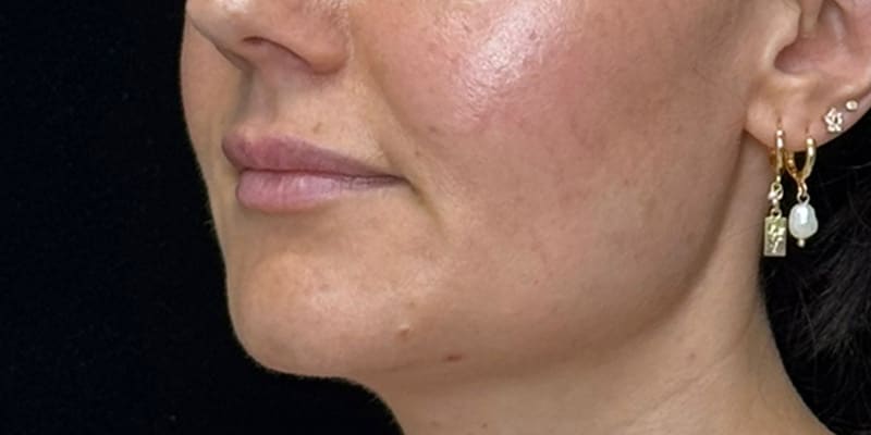 Chin Fillers Before & After Image