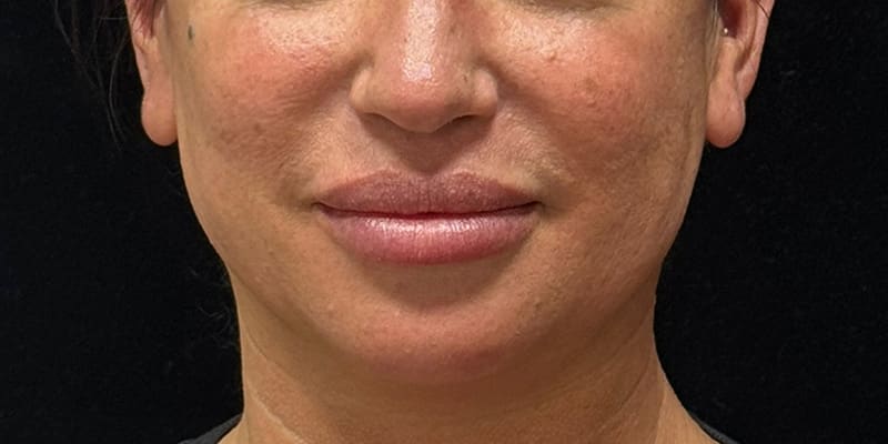 Chin Fillers Before & After Image