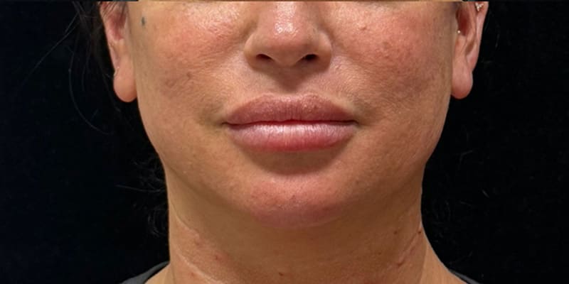 Chin Fillers Before & After Image