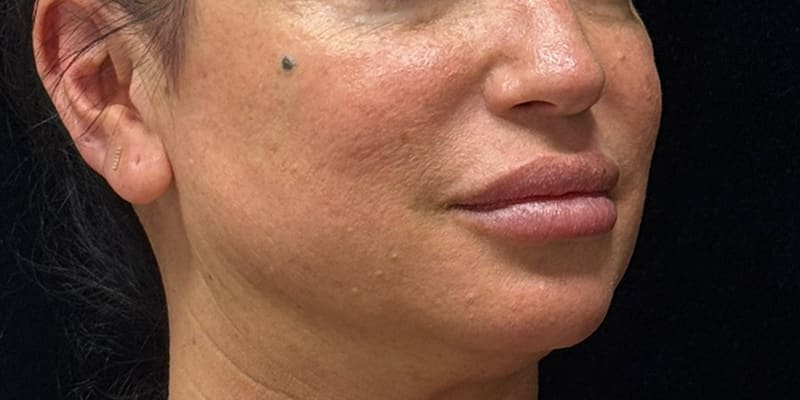 Chin Fillers Before & After Image