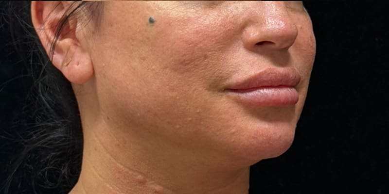 Chin Fillers Before & After Image