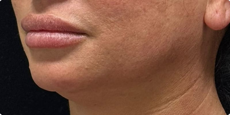 Chin Fillers Before & After Image