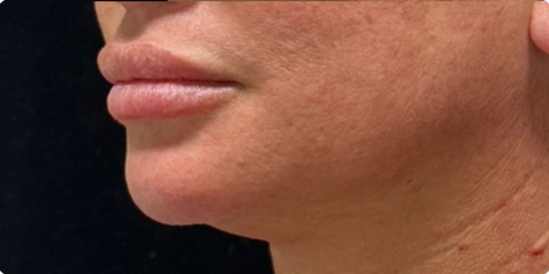 Chin Fillers Before & After Image